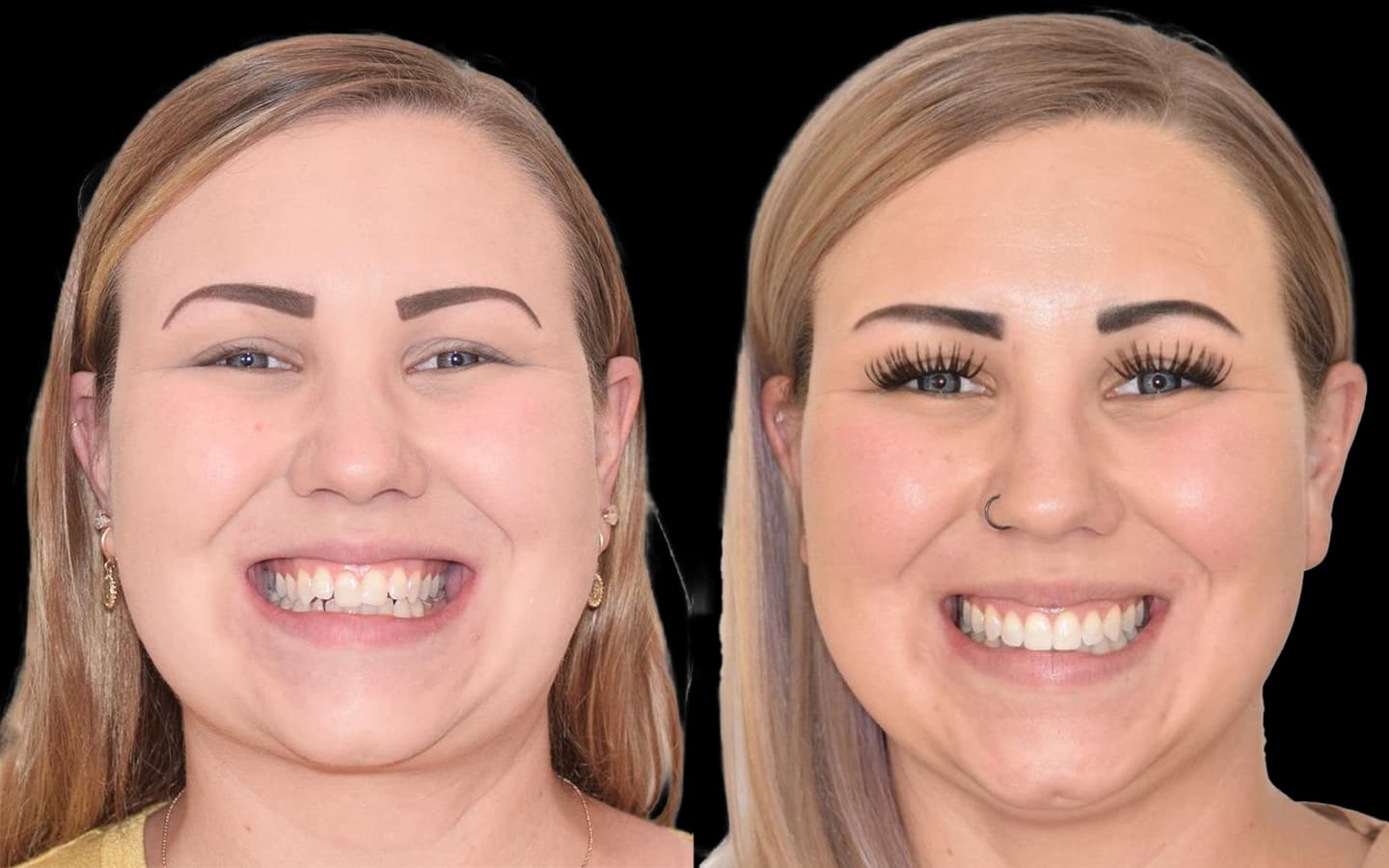 Adult before and after orthodontic treatment