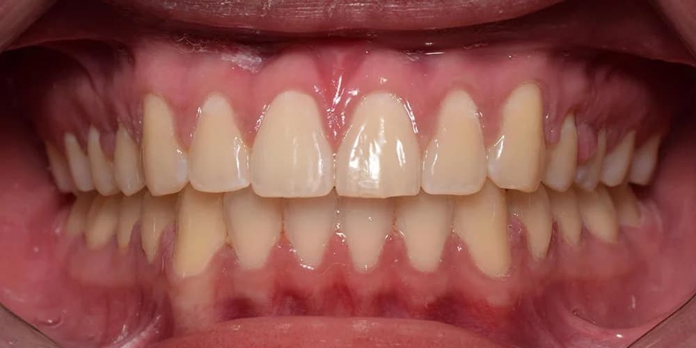 Adults case AD after treatment