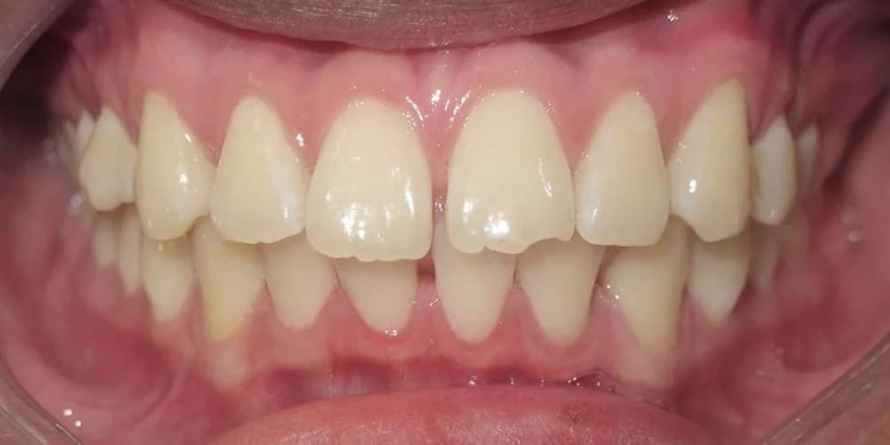 Adults case AD before treatment