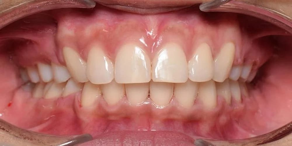 Adults case DR after treatment