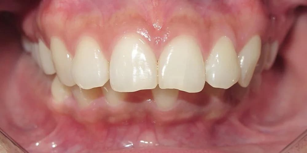 Adults case DR before treatment