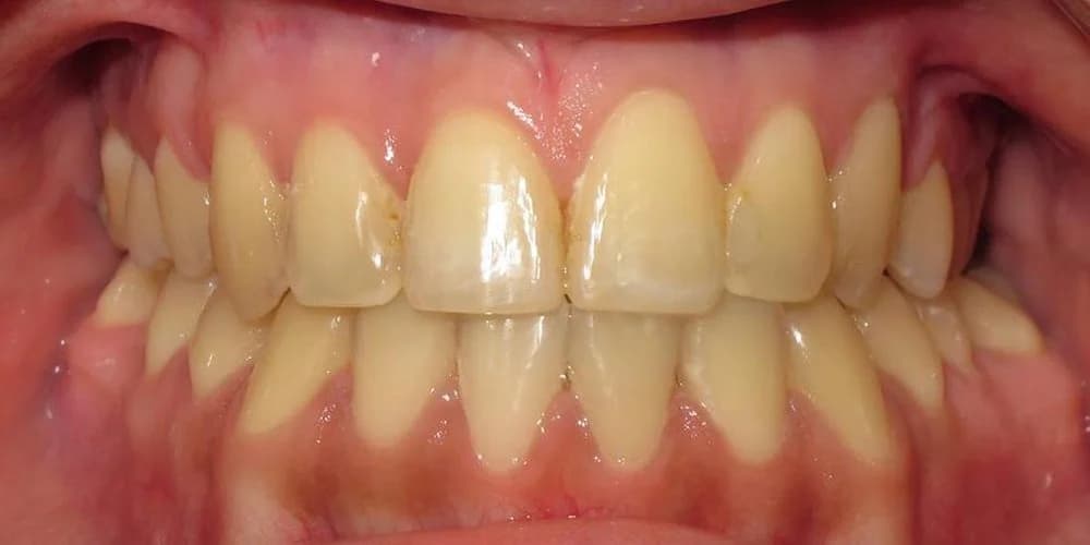 Adults case GMT after treatment