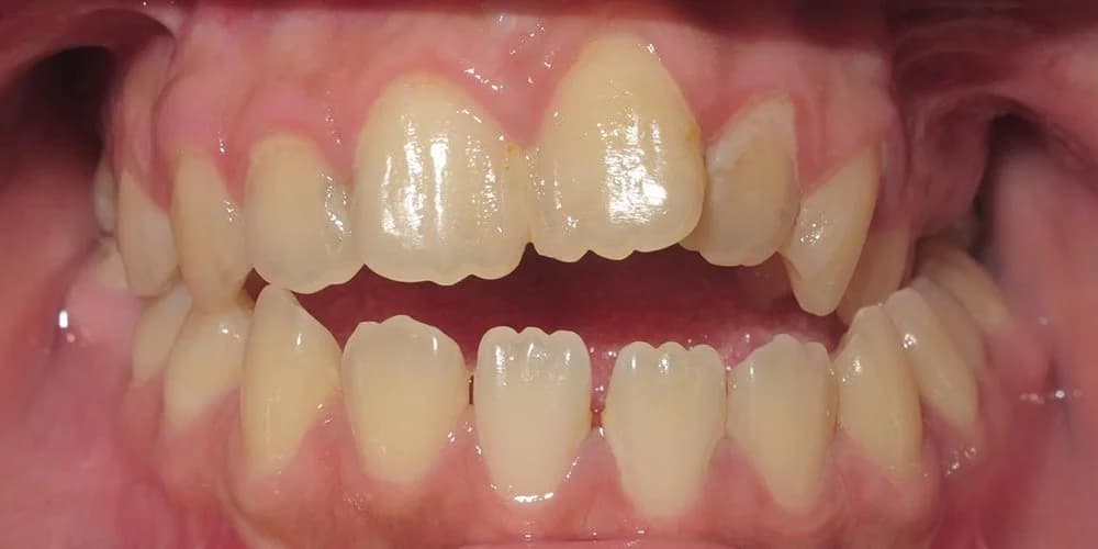 Adults case GMT before treatment