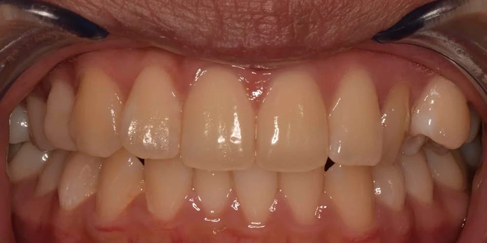 Adults case JM before treatment