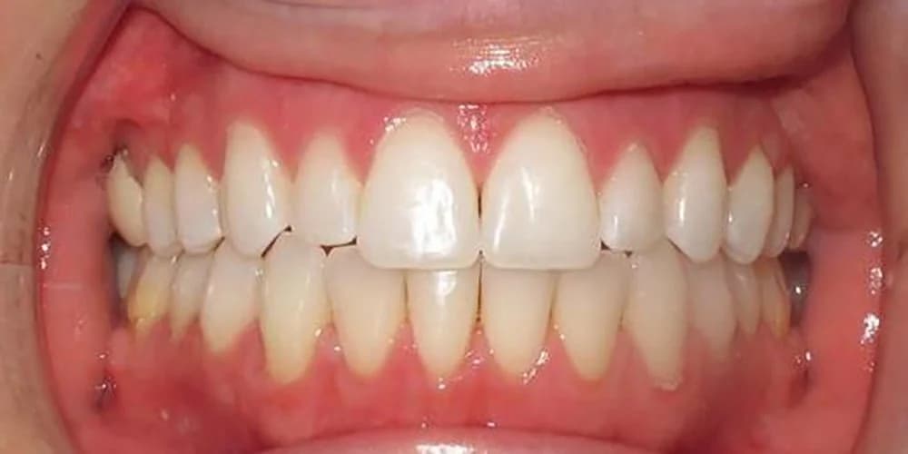 Aligners case AS after treatment
