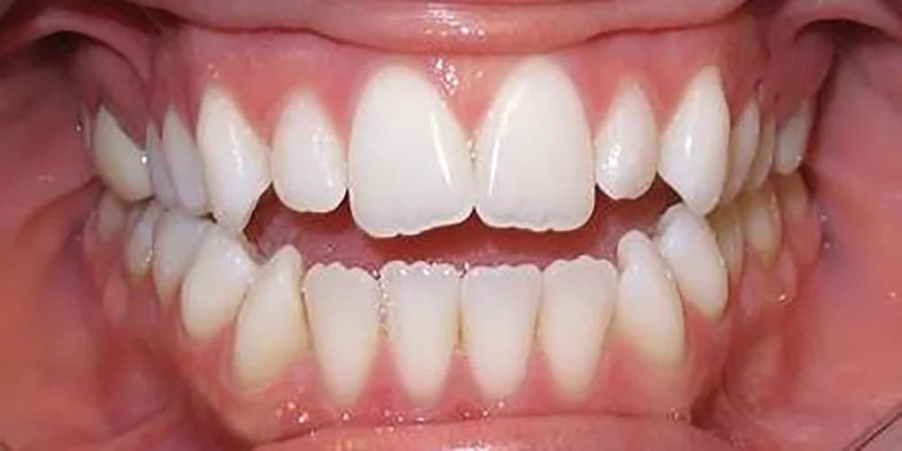 Aligners case AS before treatment