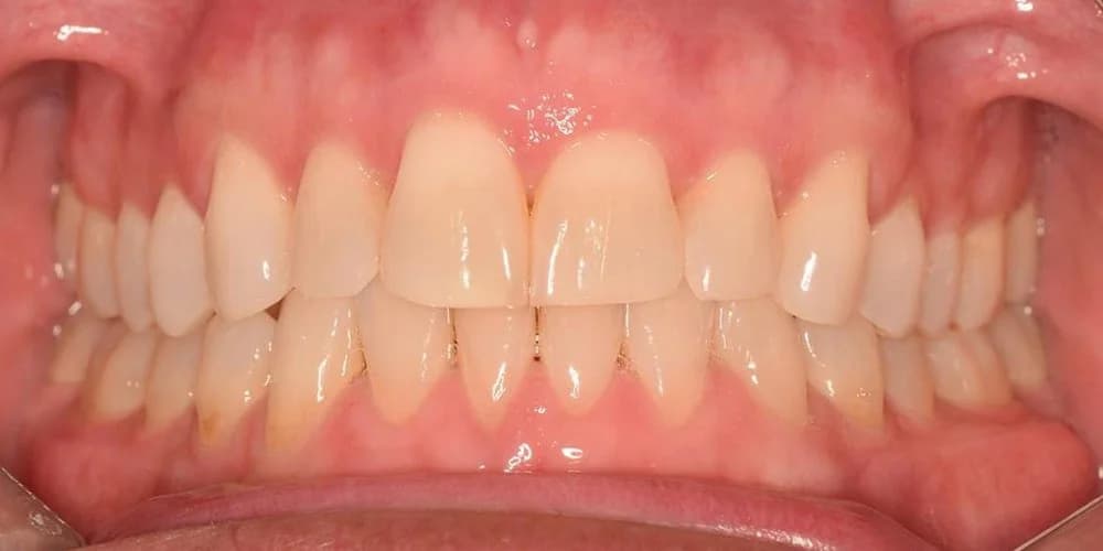 Aligners case DG after treatment