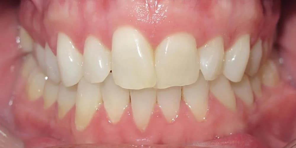 Aligners case DG before treatment