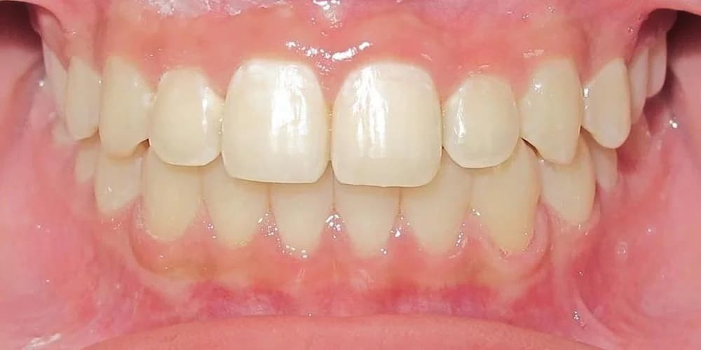 Aligners case NK after treatment