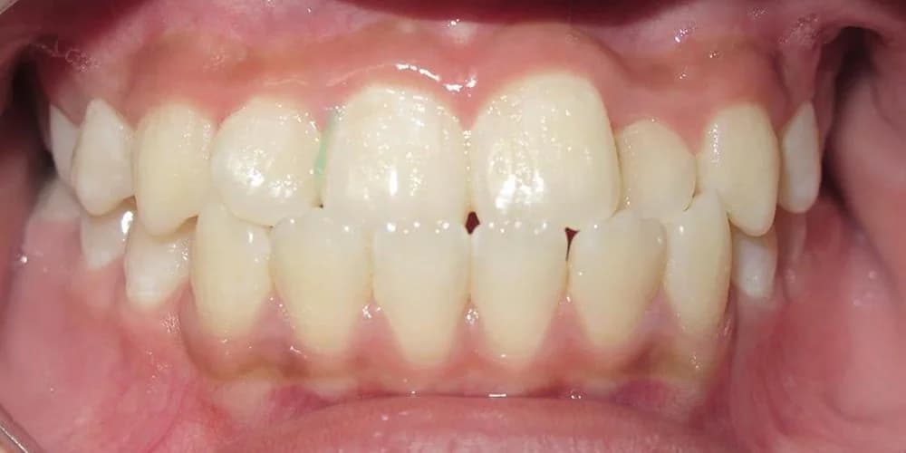 Aligners case NK before treatment