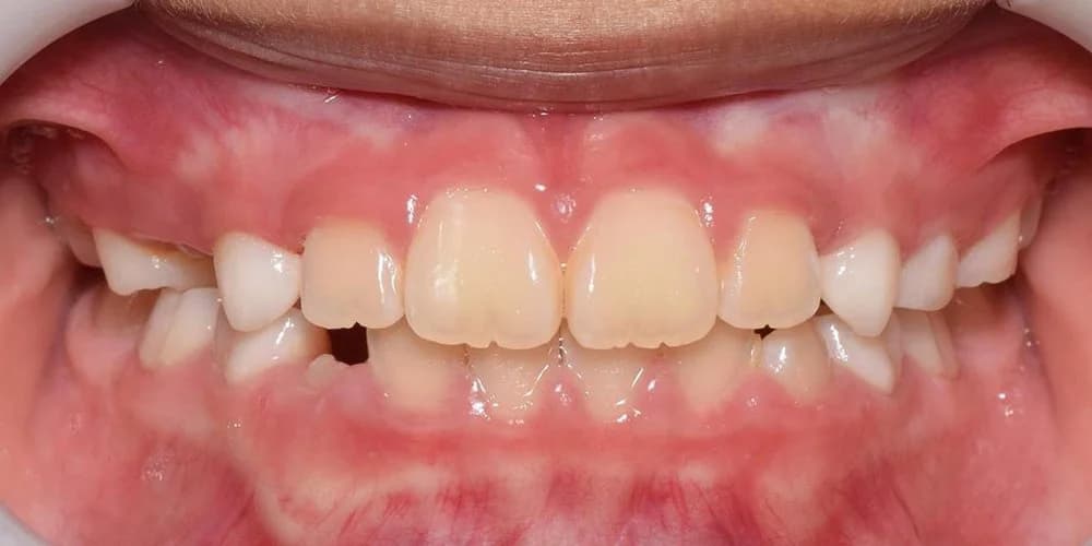 Kids Needing Early Treatment case AK after treatment