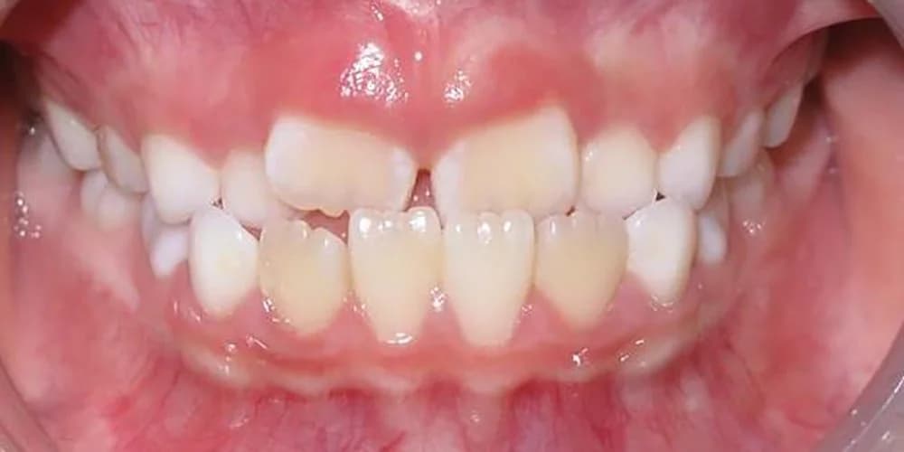 Kids Needing Early Treatment case AK before treatment