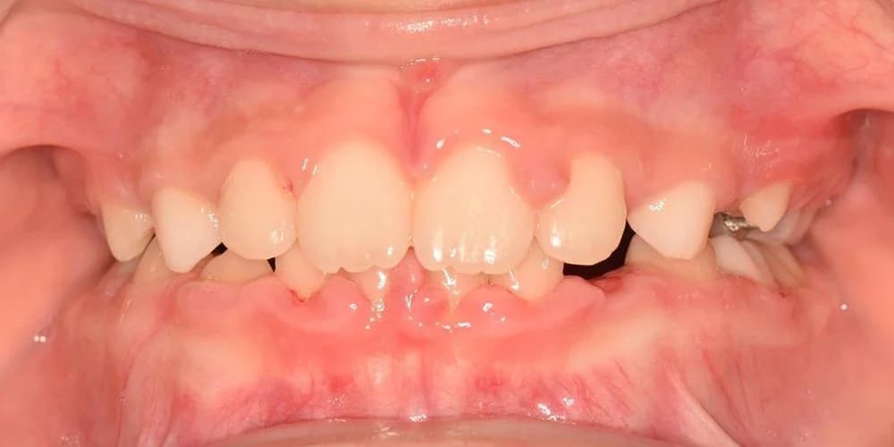 Kids Needing Early Treatment case CG after treatment