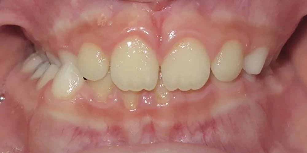 Kids Needing Early Treatment case CG before treatment