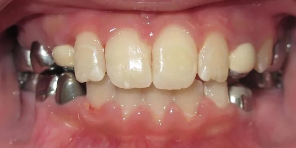 Kids Needing Early Treatment case JT after treatment