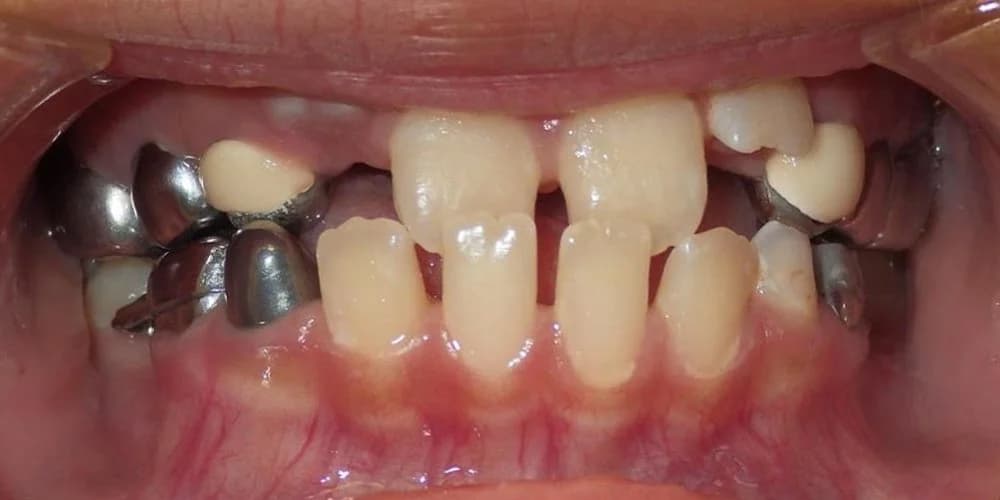 Kids Needing Early Treatment case JT before treatment