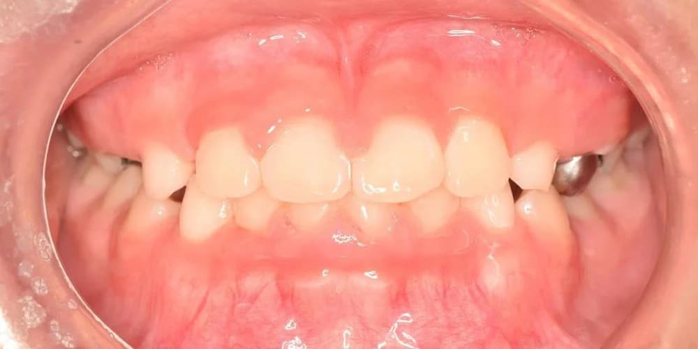 Kids Needing Early Treatment case KD after treatment