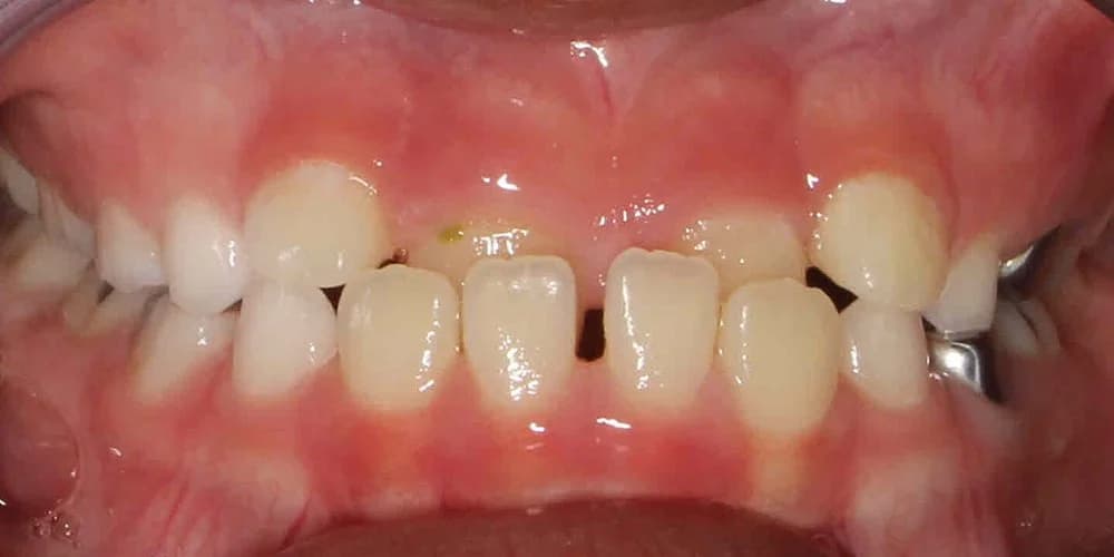 Kids Needing Early Treatment case KD before treatment