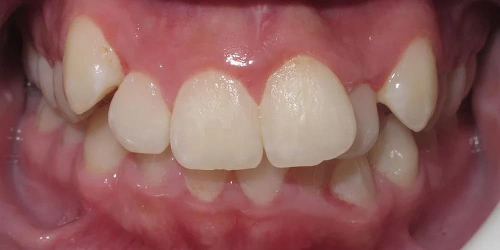 Teens case AA before treatment