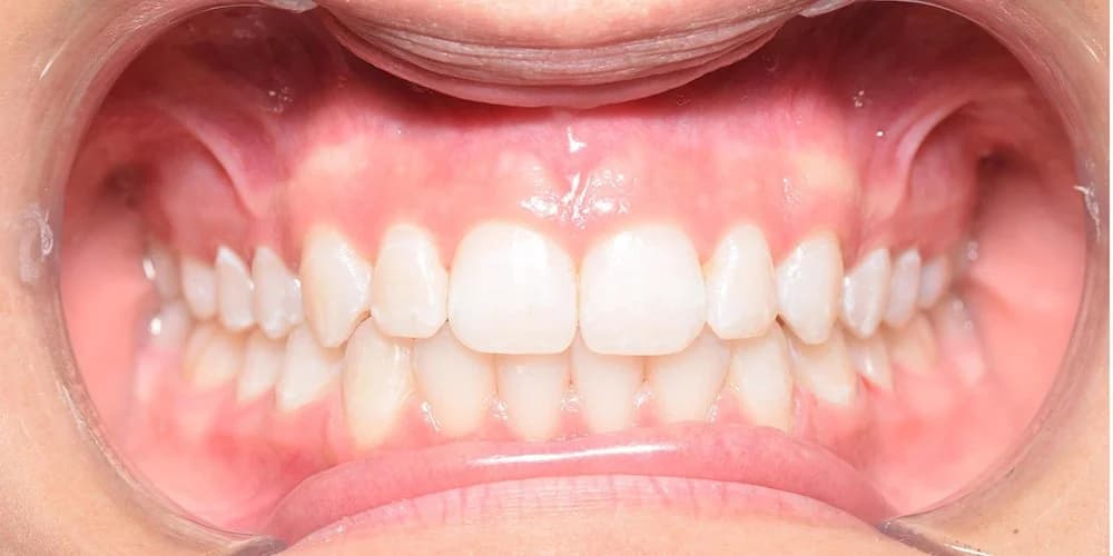 Teens case AN after treatment