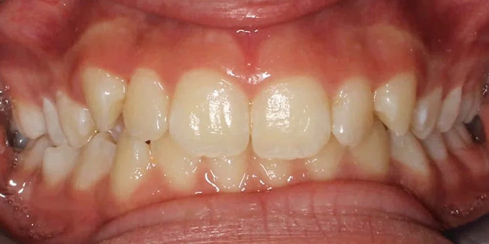 Teens case AN before treatment