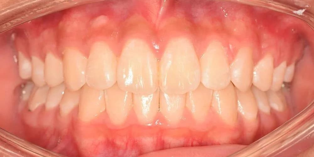 Teens case AT after treatment