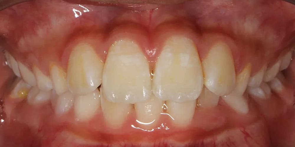 Teens case AT before treatment