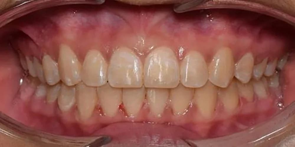 Teens case BM after treatment