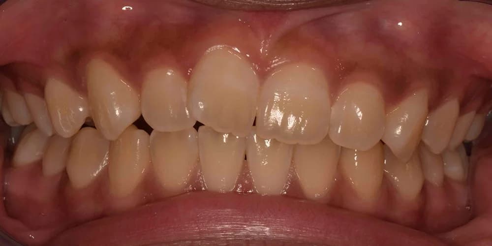 Teens case BM before treatment