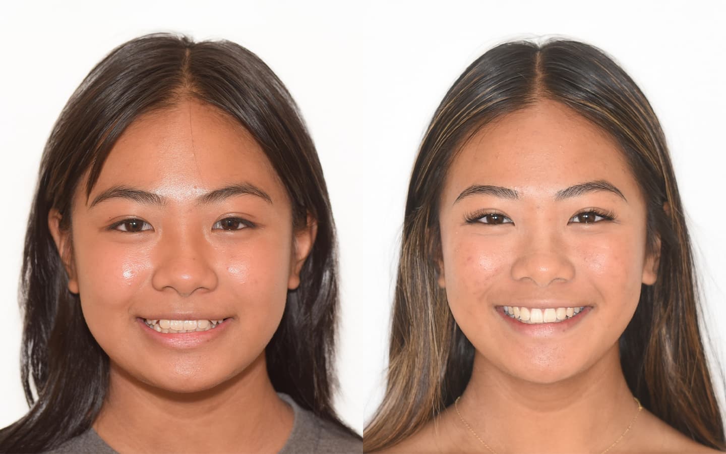 Teen before and after treatment
